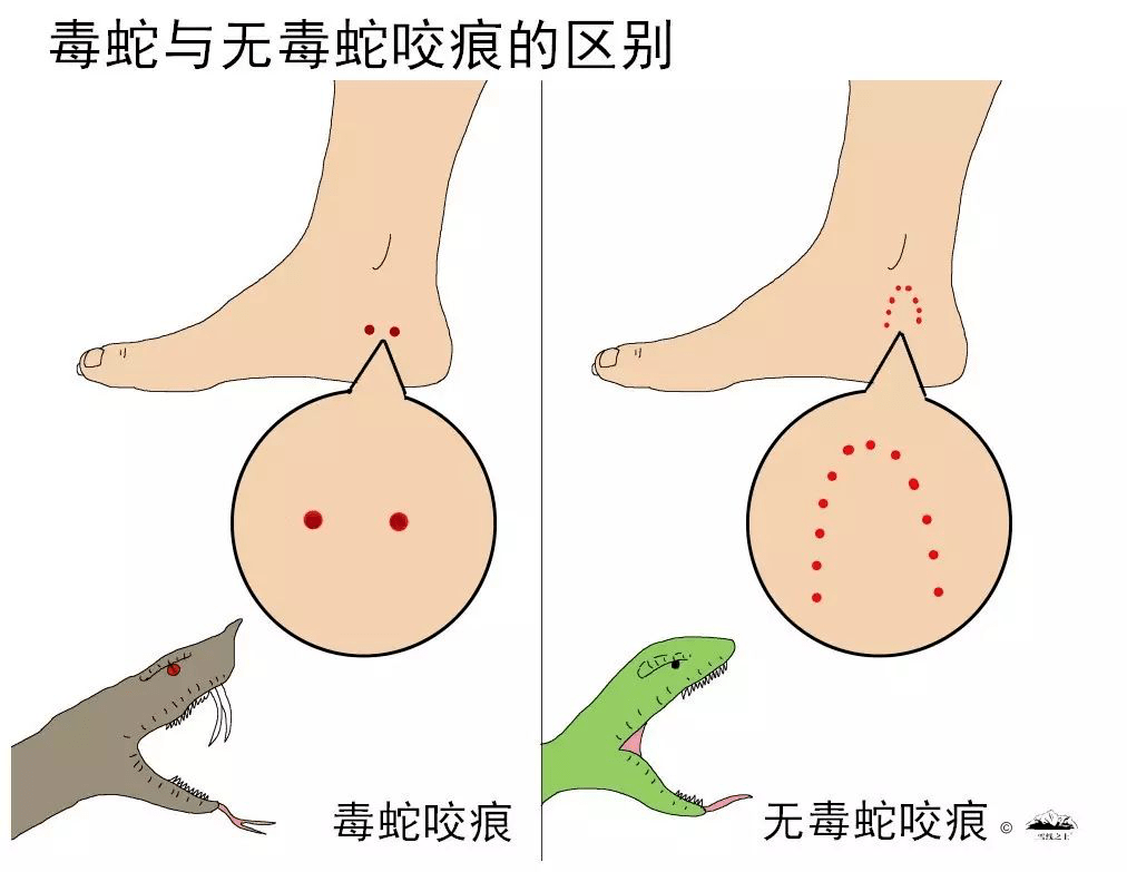 被毒蛇咬伤如何急救?揭阳市人民医院医生为市民支招_手机搜狐网