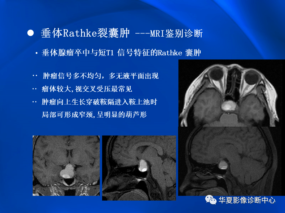 垂体rathke裂囊肿mr表现