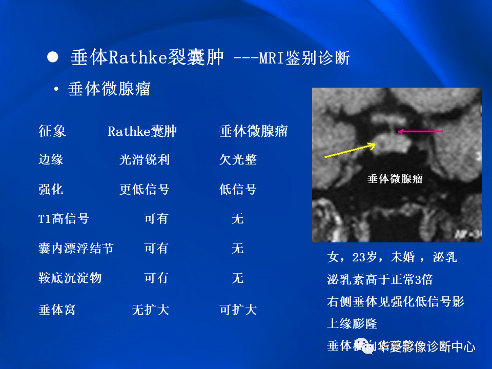 垂体rathke裂囊肿mr表现