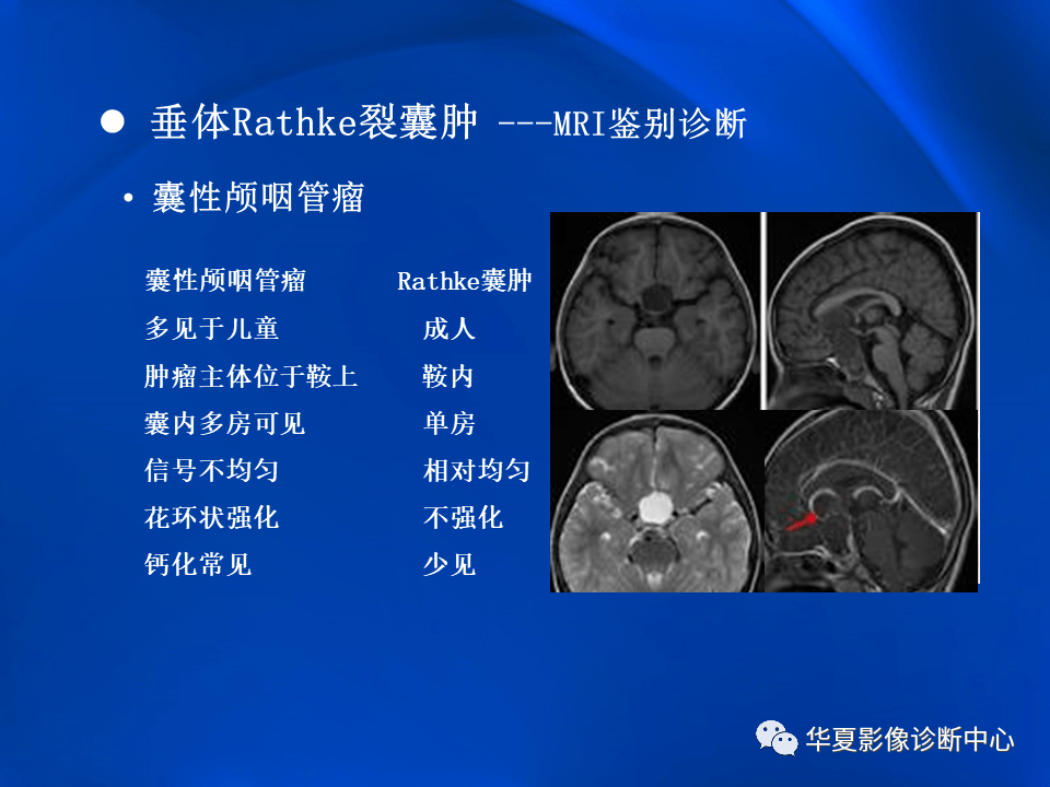 垂体rathke裂囊肿mr表现