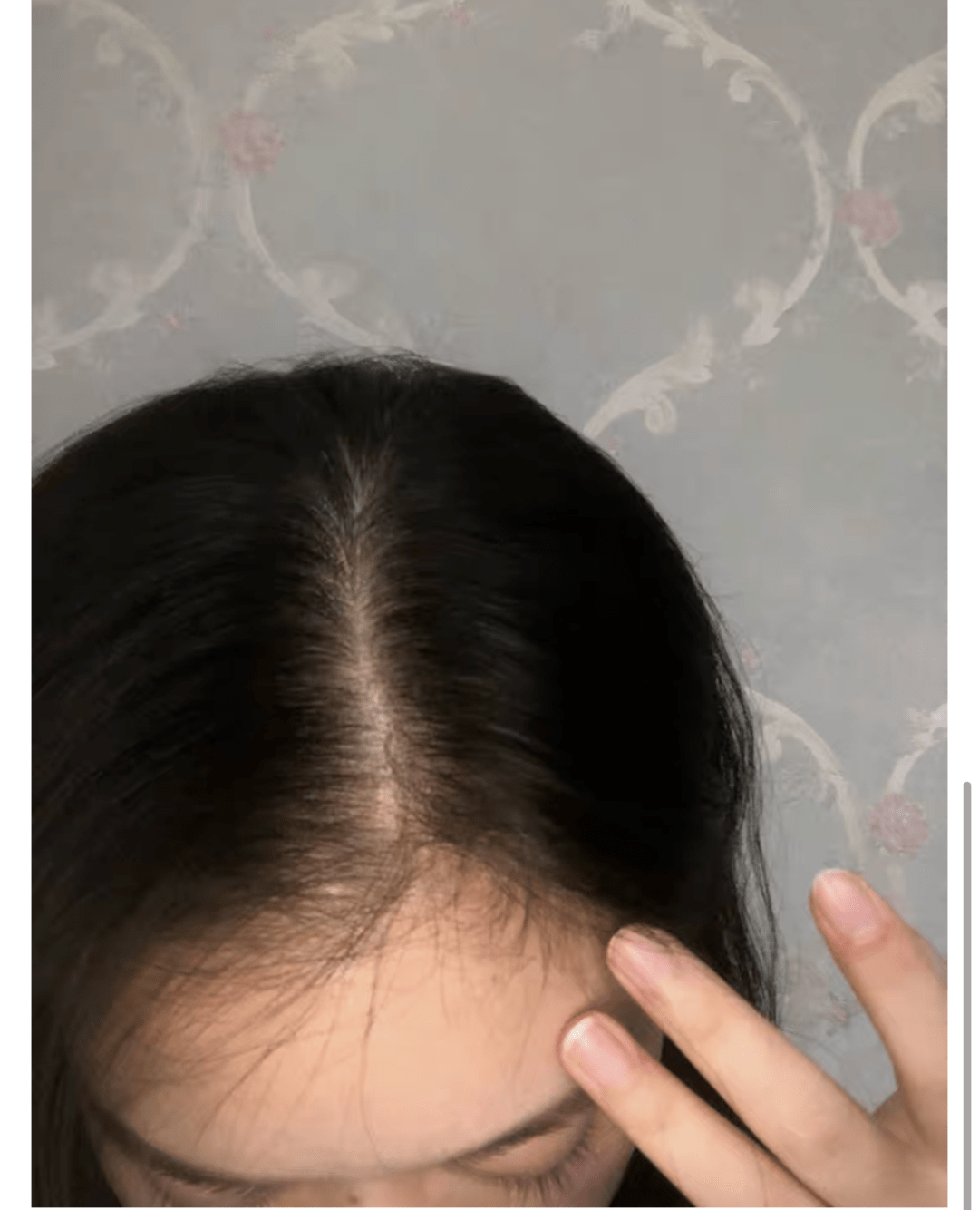 毛囊|流女星们的“狮子头”都是假象？录节目竟然当场掉下假发片，真相竟然是……
