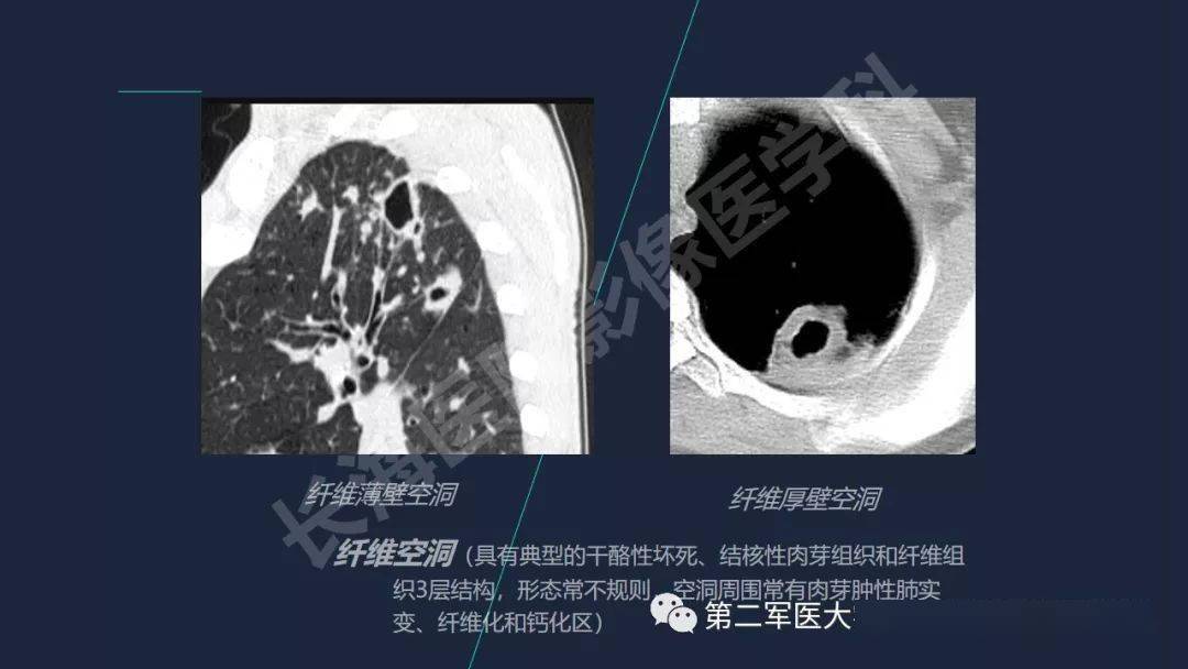 肺空洞性疾病的影像诊断