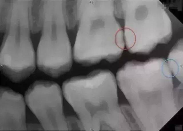举个例子:轻微的蛀牙用肉眼根本看不出来病变,但是借助拍片,就可以