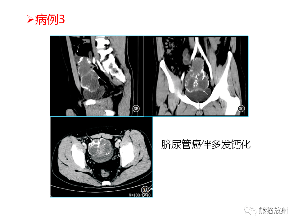 脐尿管癌,脐尿管脓肿↓ 相关内容链接:【专题】脐尿管畸形与脐尿管癌