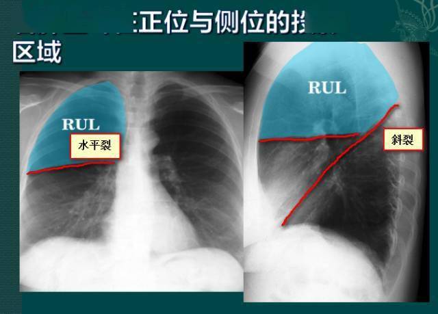 纵隔|读完此文，终于学会看胸片了