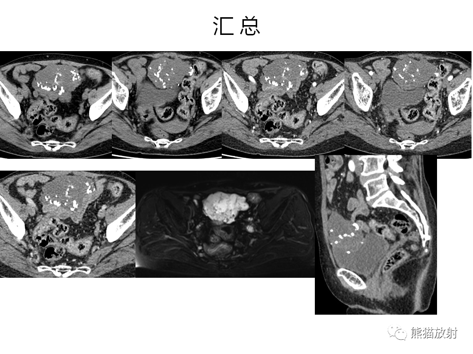 【省立影像读片】脐尿管病变 20.10