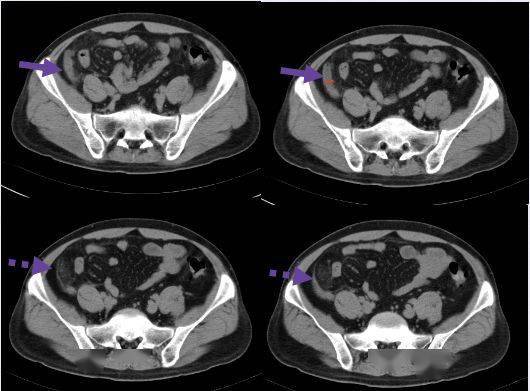 片上|CT 片上总是找不到阑尾？3 步法教你快速定位