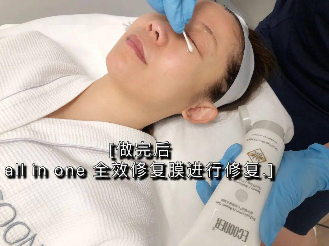 皮肤|热玛吉五代团购第2波丨热玛吉的精髓——眼部450发全纪录