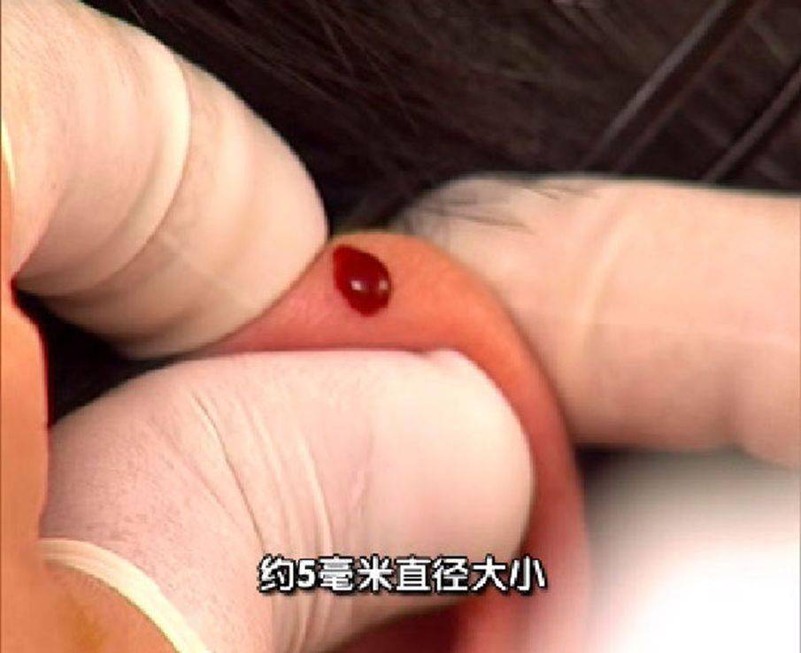 耳尖放血禁忌与适应症