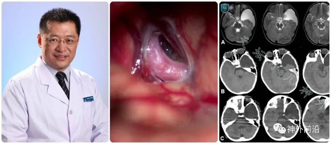 手术|天坛小儿神外 | 专访宫剑：儿童颅内蛛网膜囊肿的治疗策略及天坛规范(上)
