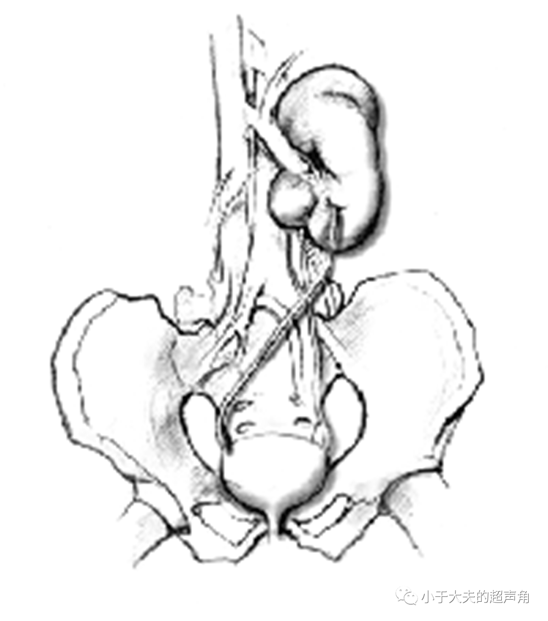 诊断|【超声随响】第21期 肾脏先天性发育异常 诊断肾缺如要谨慎！