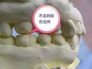 五种常见不合格牙模的处理办法