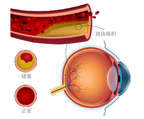 视网膜静脉阻塞,是一种常见的视网膜血管病,是由于眼底血管的血液动力
