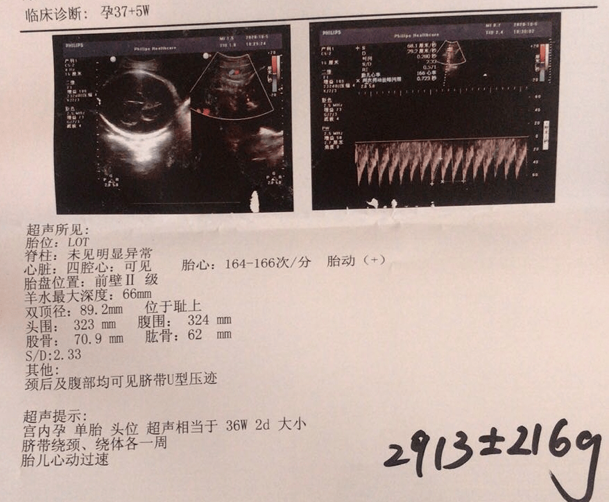 "魏明医生警惕起来,一边询问着一遍查看萌萌的b超报告, "孕37 5周