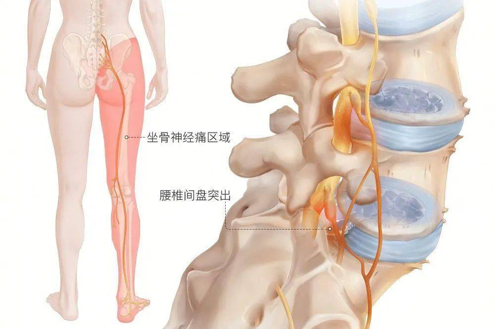 腰椎间盘突出的介入治疗是什么原理