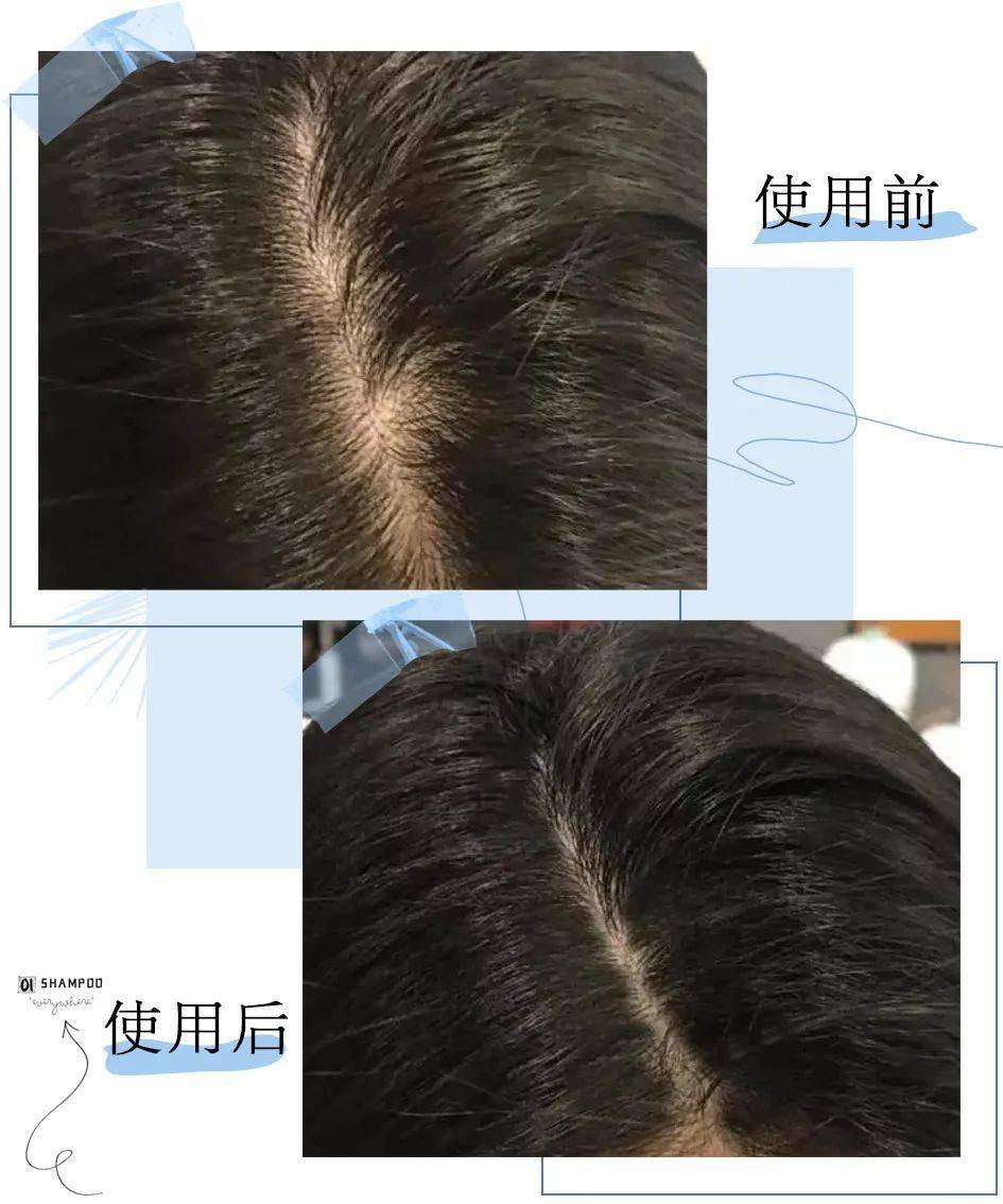 克兰|头上抠下的“白泥”，居然不是头皮屑？脱发头油都是因为它？