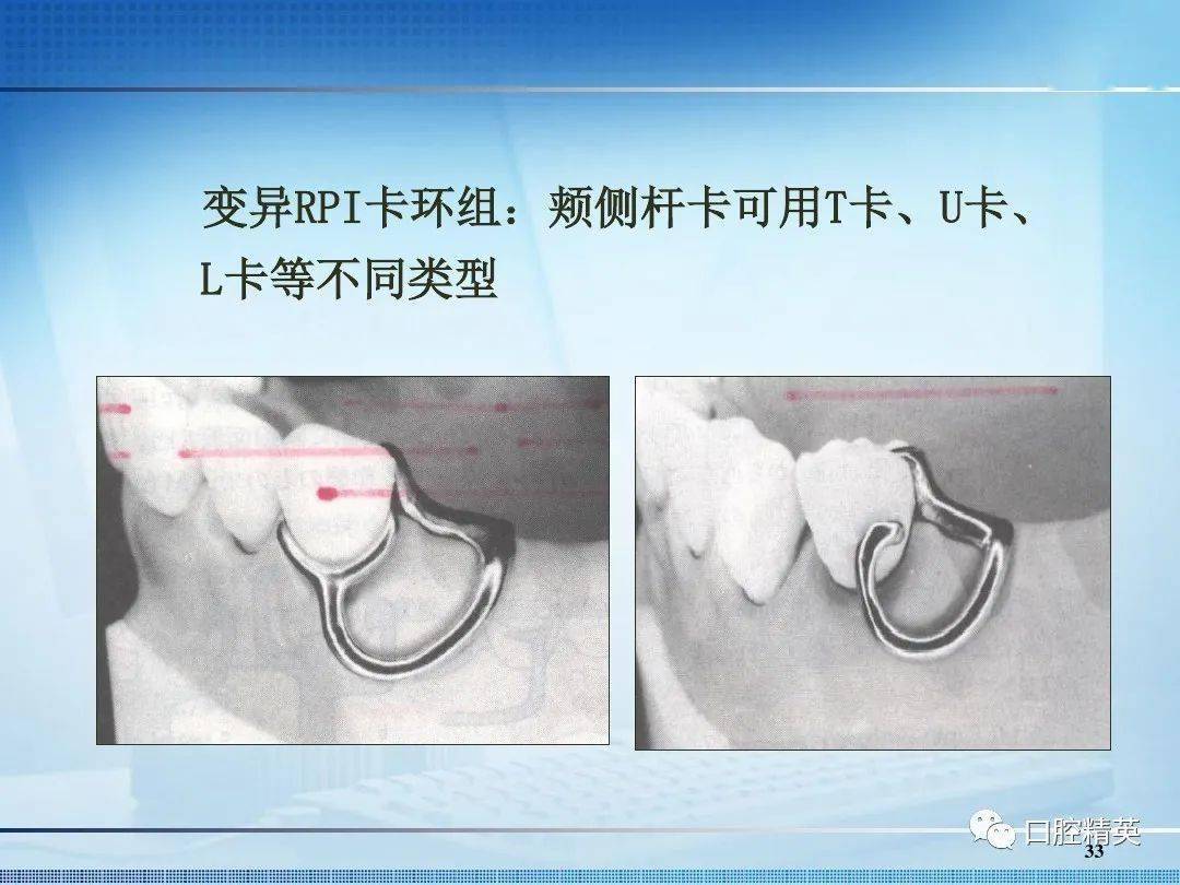 注:文章点赞过50 下期更新《卡环弯制》返回搜狐,查看更多