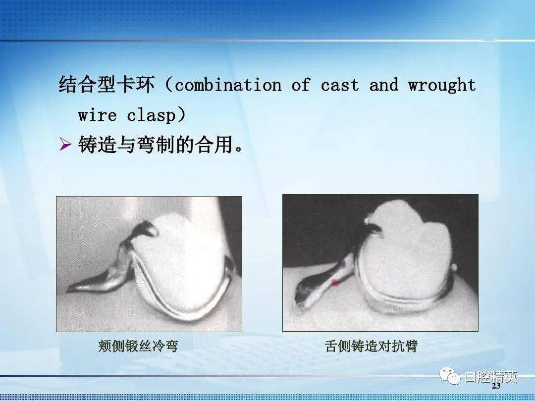 可摘局部义齿卡环的种类