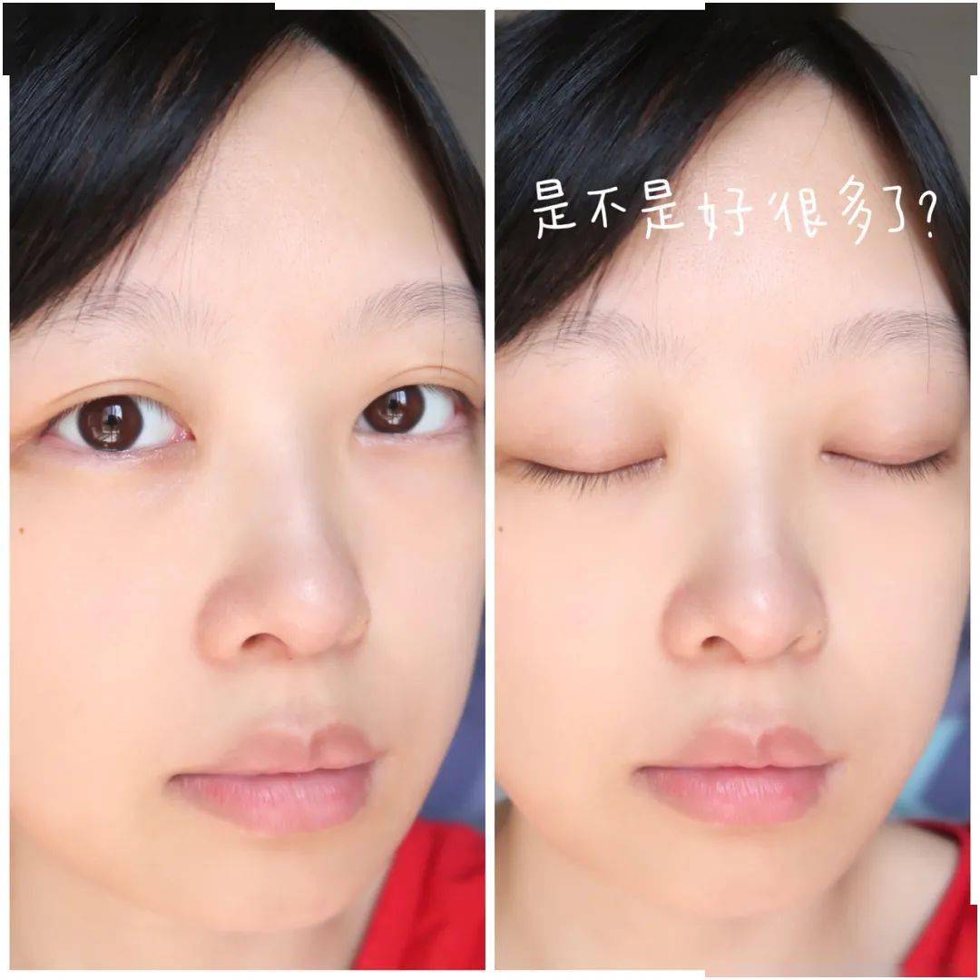 鱼尾纹|黑眼圈、肿眼泡、鱼尾纹，眼睛到底有多暴露年龄？