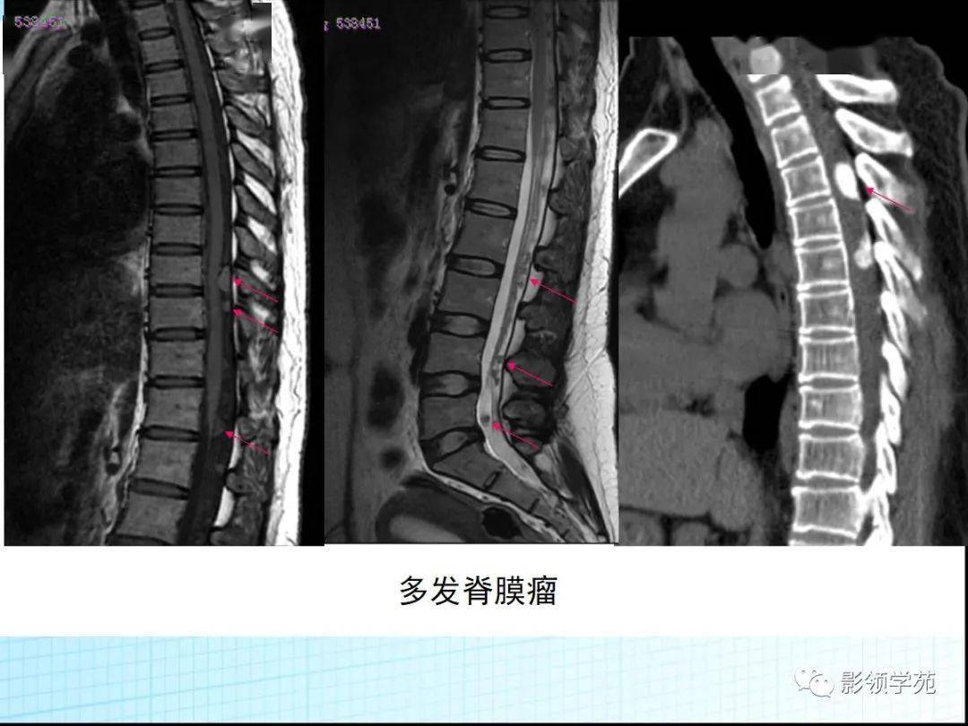 神经纤维瘤病影像表现