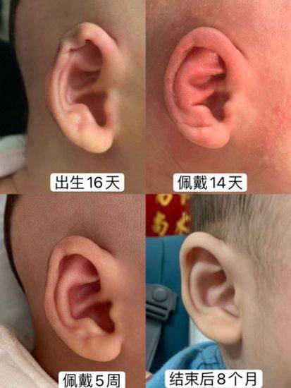 耳廓|宝宝耳廓不正常多拉拉就好?专家:应尽早矫正