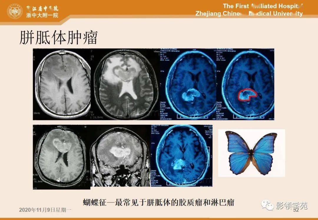 5类胼胝体病变的影像学表现