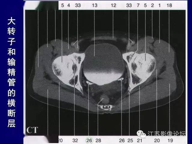 男性盆部断层解剖图谱