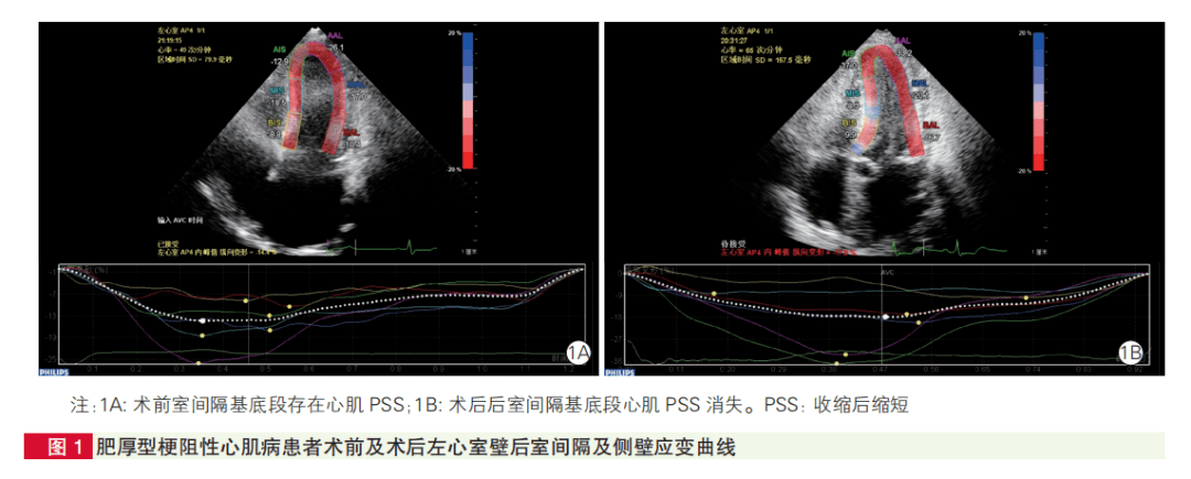 评估肥厚型心肌病手术效果有新超声指标!阜外医院王浩等研究