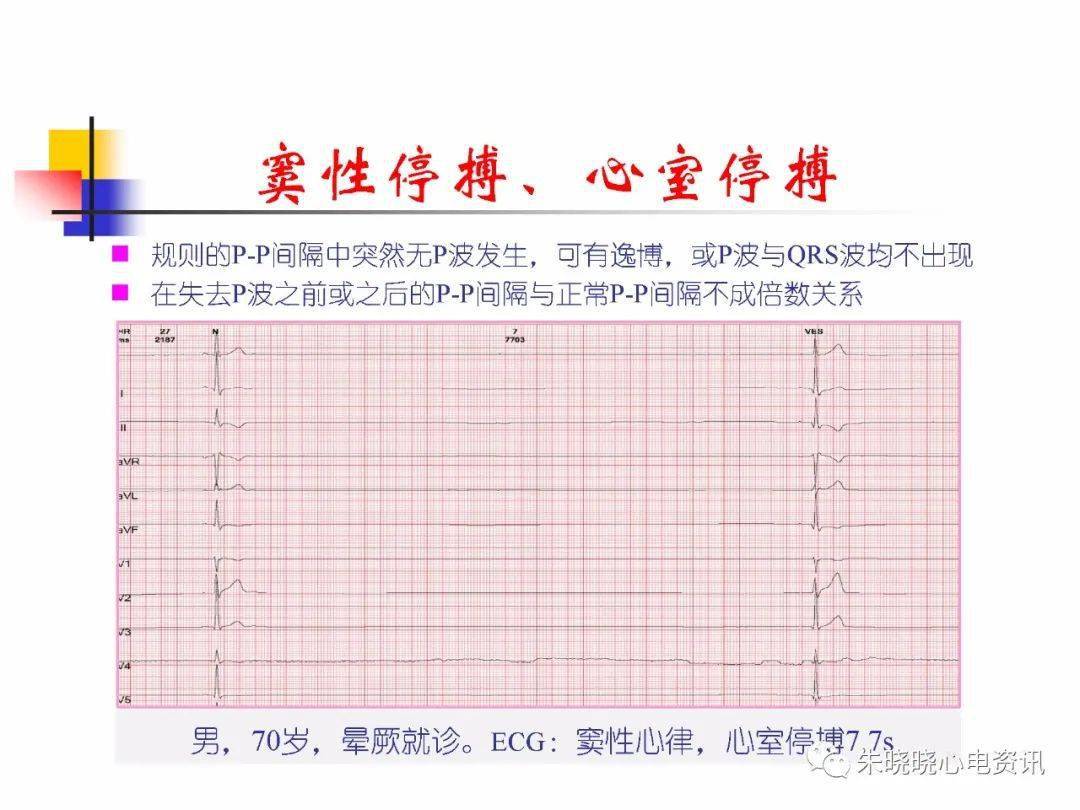 心电图危急值识别与处理