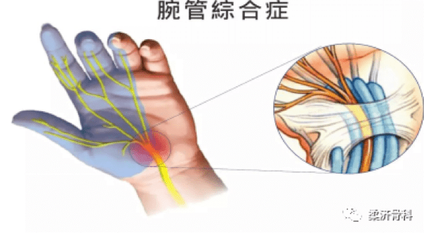 办公族女性最易得"鼠标手"!这样预防最重要!