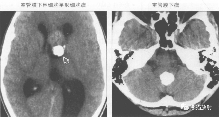 鉴别诊断——脑室内钙化