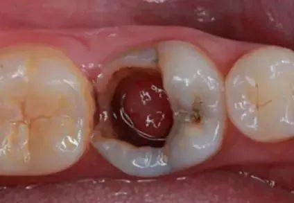 当怀疑是牙龈息肉时,可自蒂部将其切除,见出血部位在患牙邻面龋洞龈壁