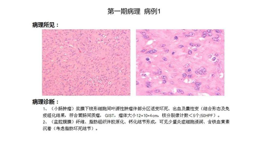 读片|浙江省肿瘤医院放射科读片会（第二期）