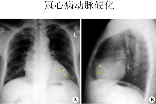 x线中的心影增大你真的会看吗