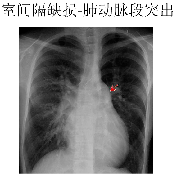 x线中的心影增大你真的会看吗