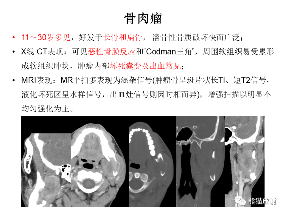 下颌骨鳞状细胞癌,牙龈鳞状细胞癌 返回搜