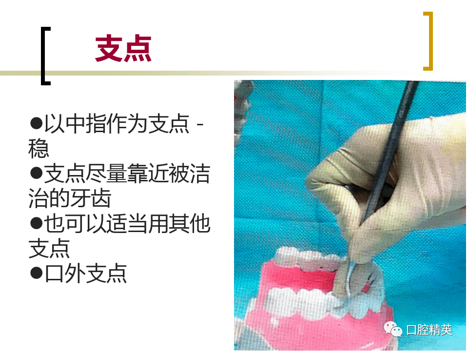 龈上洁治术