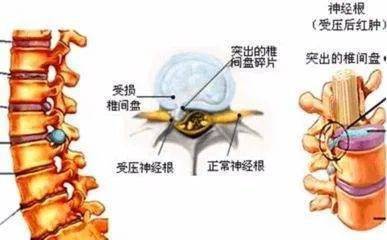 按摩治疗腰间盘突出是什么原理(3)