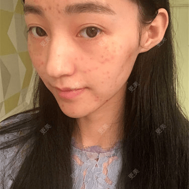 皮肤|杨幂早期合照见心机？看完原图呆了，她们这么早竟都整了...