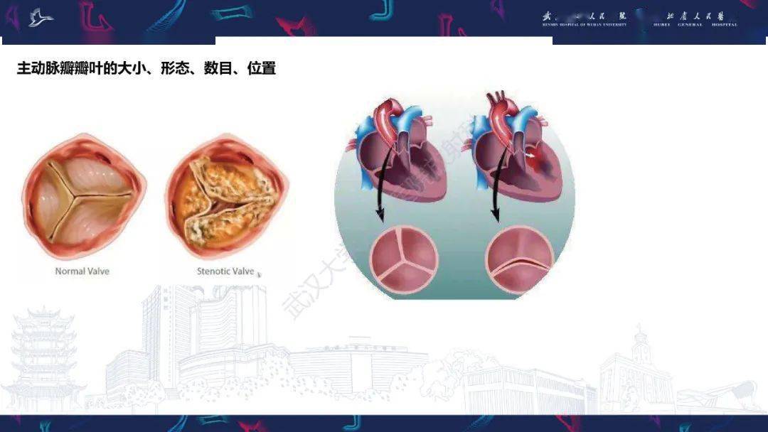 tavr围手术期ct影像学评估