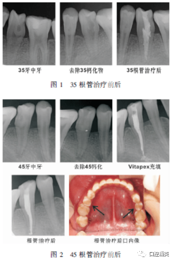 双侧下颌前磨牙牙中牙伴根尖周炎1例