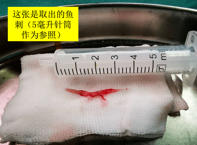 一个月拔500根鱼刺!富阳阿姨开胸取刺才保住命,都怪一碗酸菜鱼!