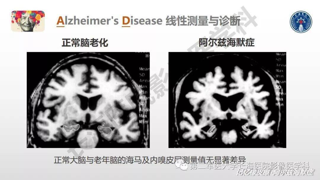 阿尔兹海默症—临床与影像