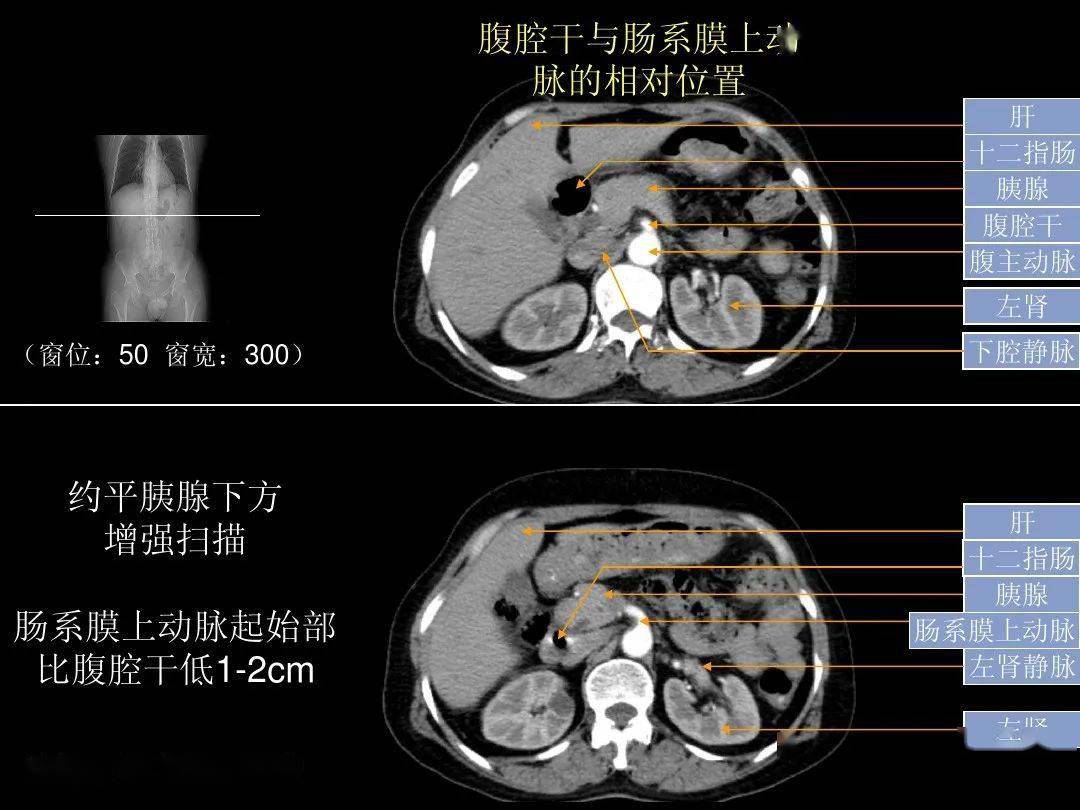 腹部ct入门解剖图谱收藏版