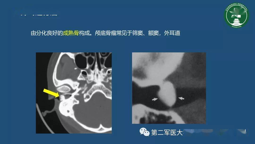 颞骨ct解剖及其常见病变