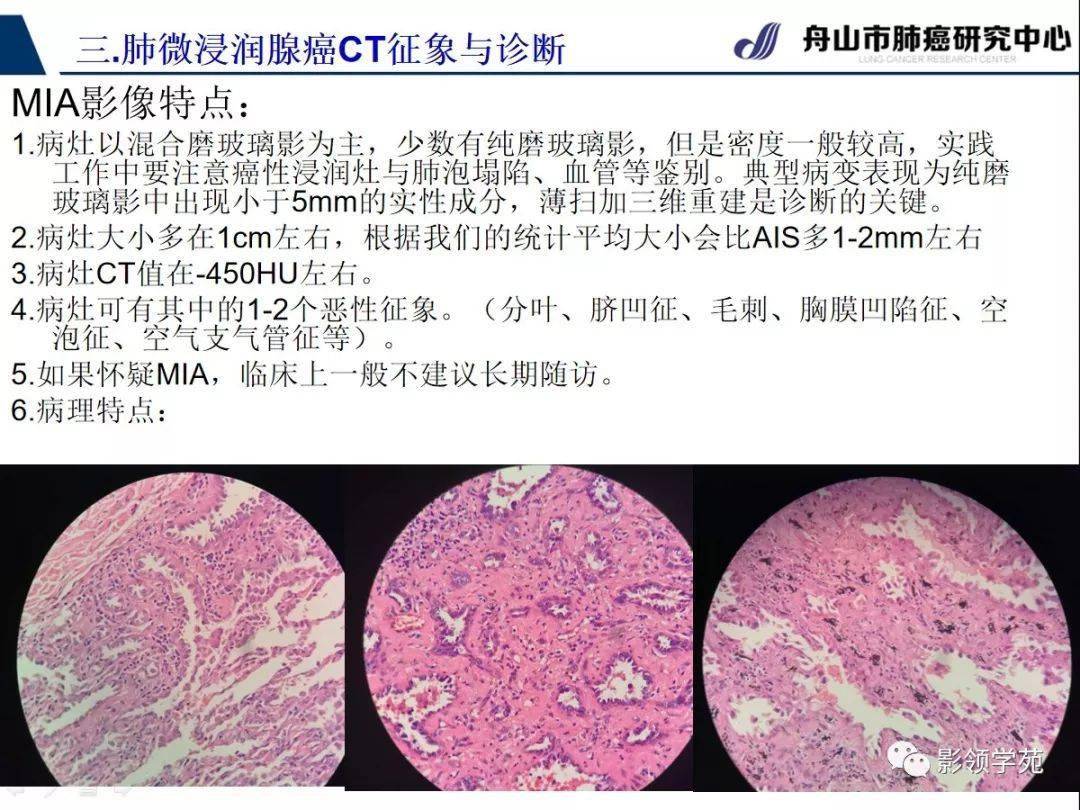 微浸润肺腺癌(mia)