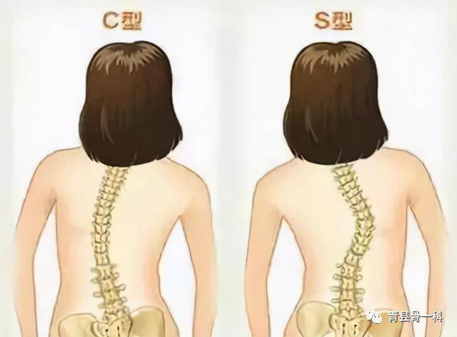什么是脊柱侧弯先天性脊柱侧弯与特发性脊柱侧弯的区别是什么