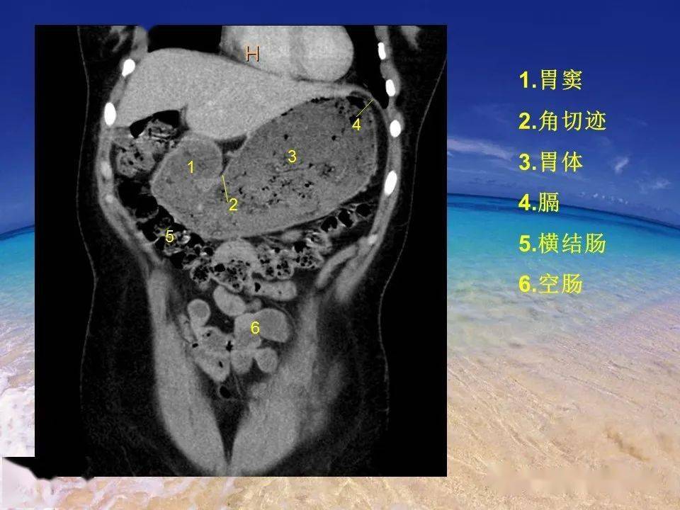 消化道穿孔的ct诊断