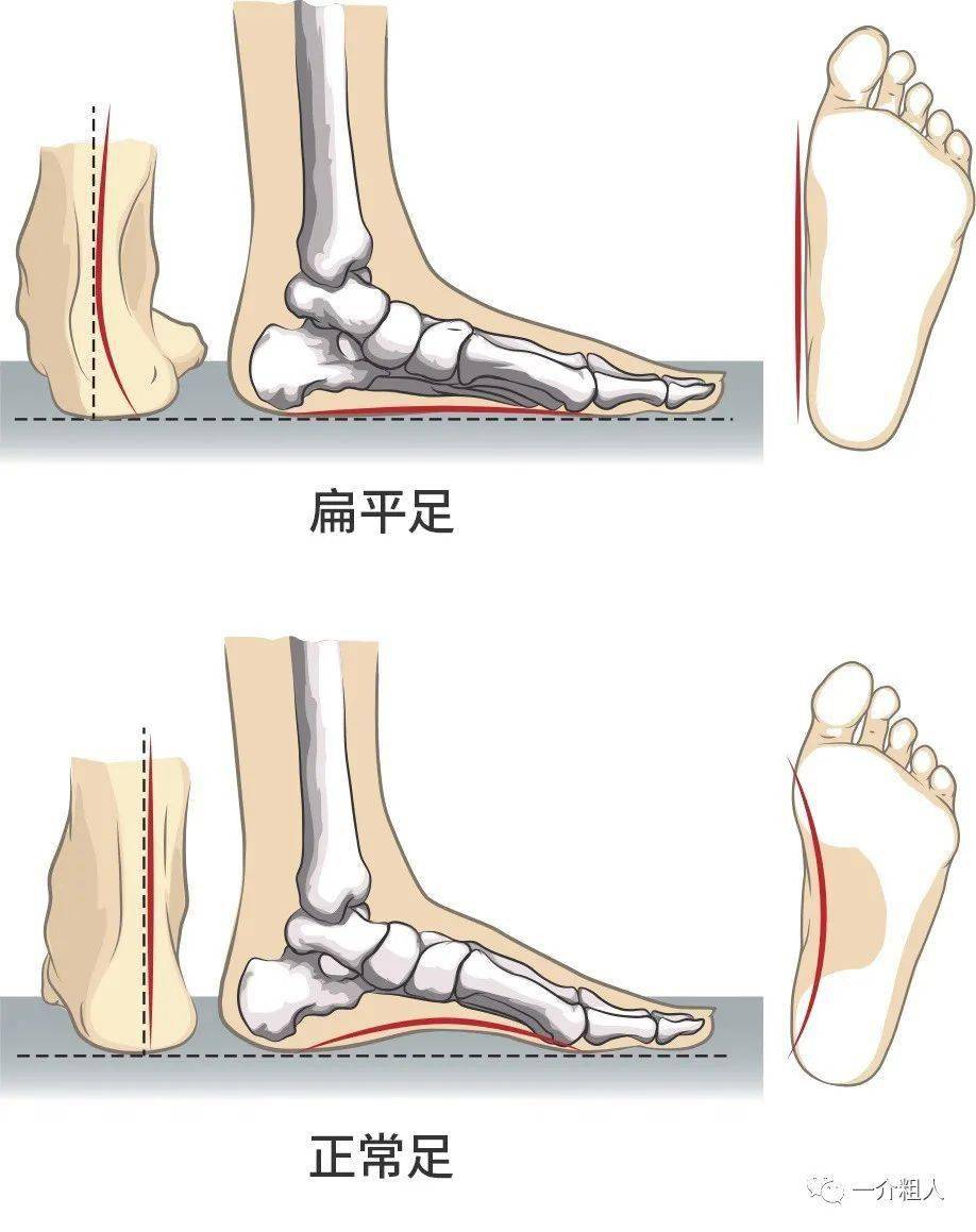 内侧足弓消失,脚掌的支撑面从前足,中足的外侧,足跟变成了完整的脚面