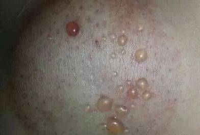 老人口里有痰怎么办_老人干咳有痰什么药(3)